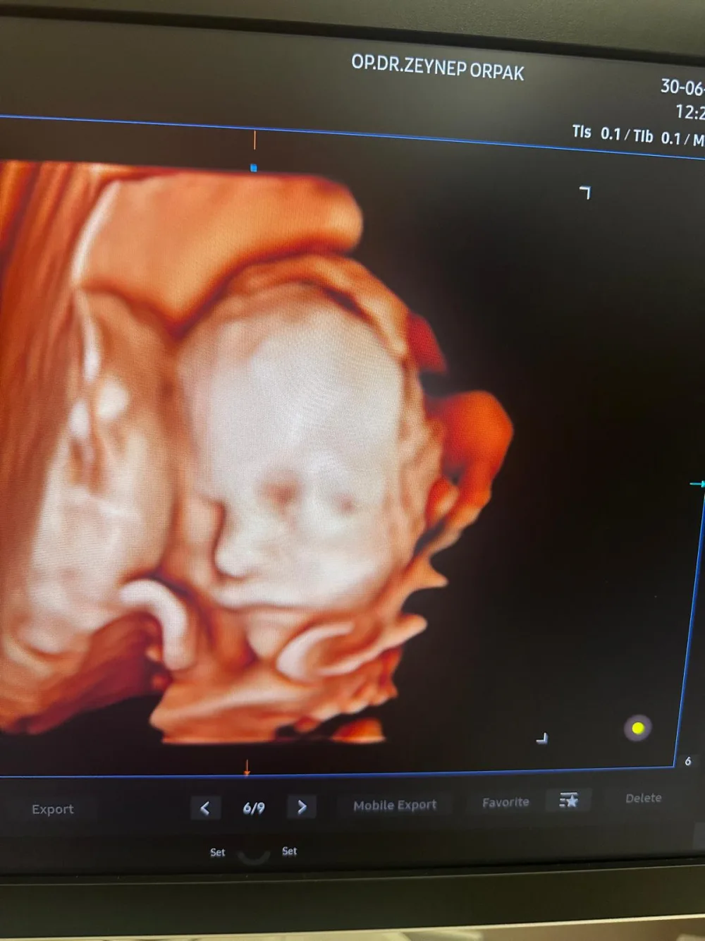4D ultrason bebek yüz görüntüsü