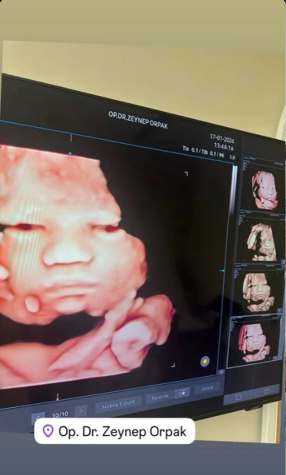 4D ultrason ekranı — Op. Dr. Zeynep Orpak